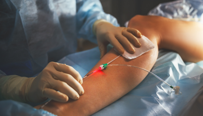 Tratamento de varizes a laser pelo Bradesco Saúde