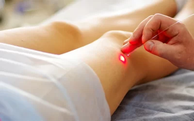 Tudo sobre tratamento a laser para varizes pela Allianz