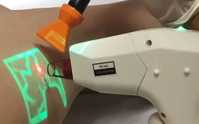 Laser transdérmico: tecnologia moderna no combate às varizes