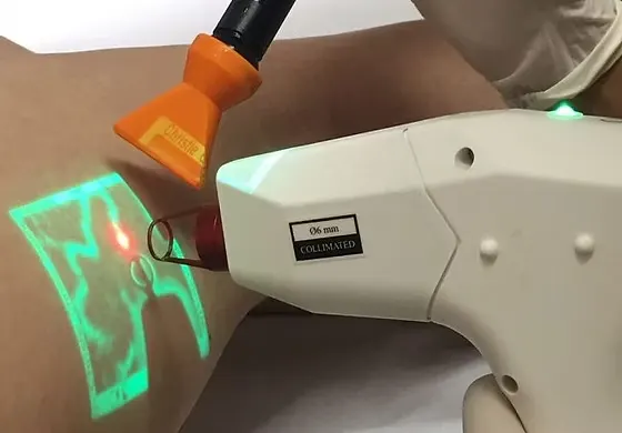 Laser transdérmico: tecnologia moderna no combate às varizes