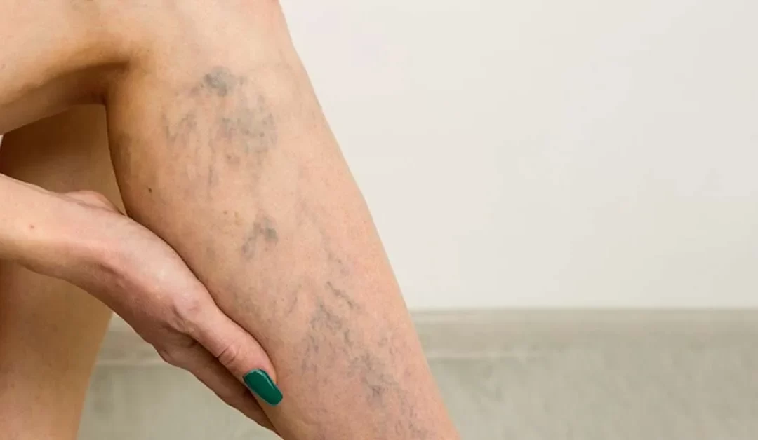 Flebectomia: cirurgia convencional para remoção de varizes