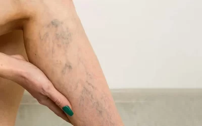 Flebectomia: cirurgia convencional para remoção de varizes