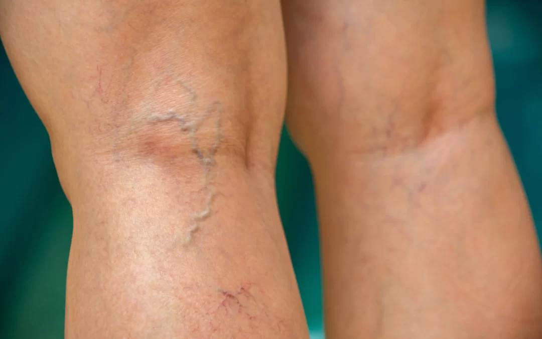 Melhor tratamento para varizes em São Paulo com o Dr. Maffei