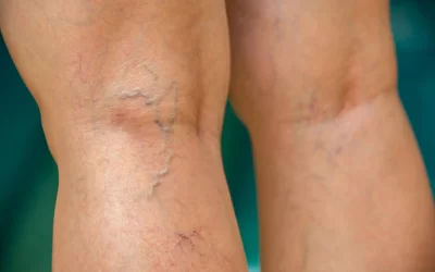 Melhor tratamento para varizes em São Paulo com o Dr. Maffei