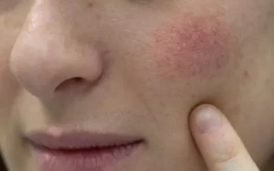 Laser para vasos no rosto: saiba como funciona o tratamento