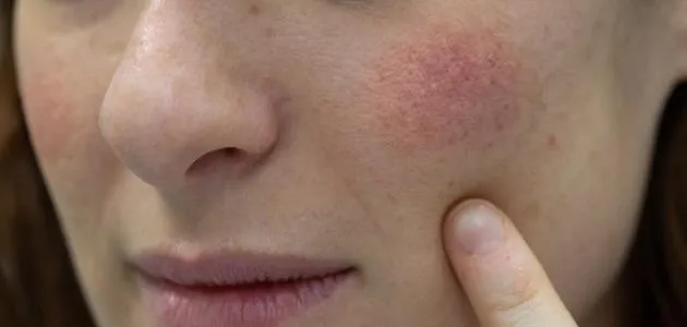 Laser para vasos no rosto: saiba como funciona o tratamento