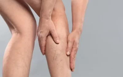 Varicorragia: entenda os riscos e os tratamentos disponíveis