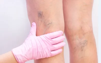 Varizes e vasinhos: qual a diferença?