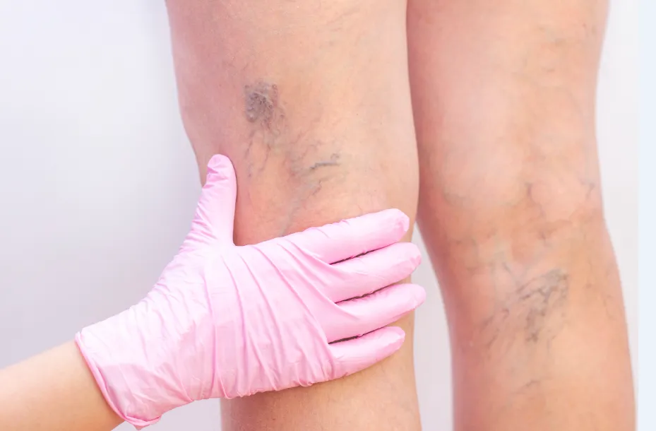 Varizes e vasinhos: qual a diferença?