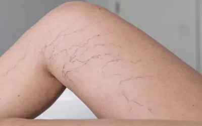 Especialista em varizes em SP: tratamento seguro e eficaz