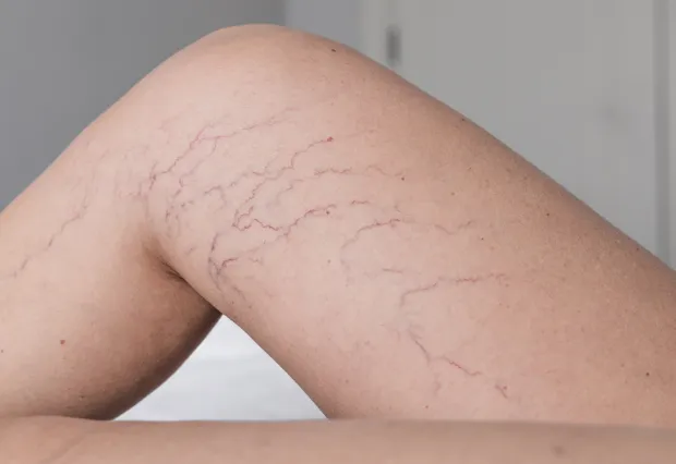 Especialista em varizes em SP: tratamento seguro e eficaz