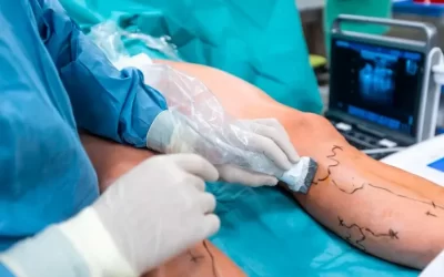 Aplicação de varizes: aplicações comuns e detalhes