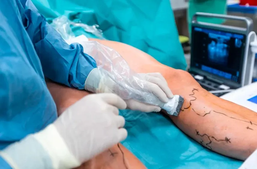 Aplicação de varizes: aplicações comuns e detalhes