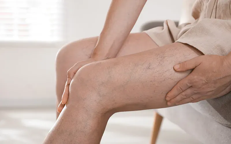 Cirurgia de varizes: quando o tratamento é indicado?