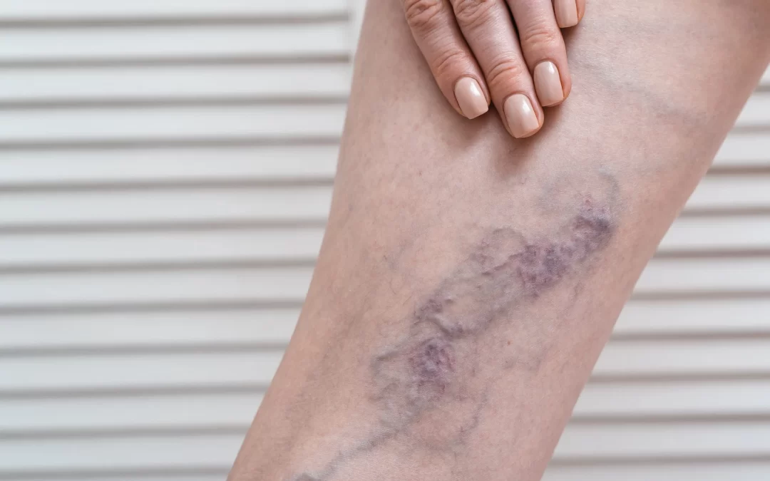 O que importa na hora de escolher um especialista em varizes