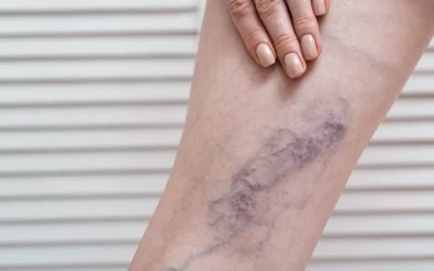 O que importa na hora de escolher um especialista em varizes