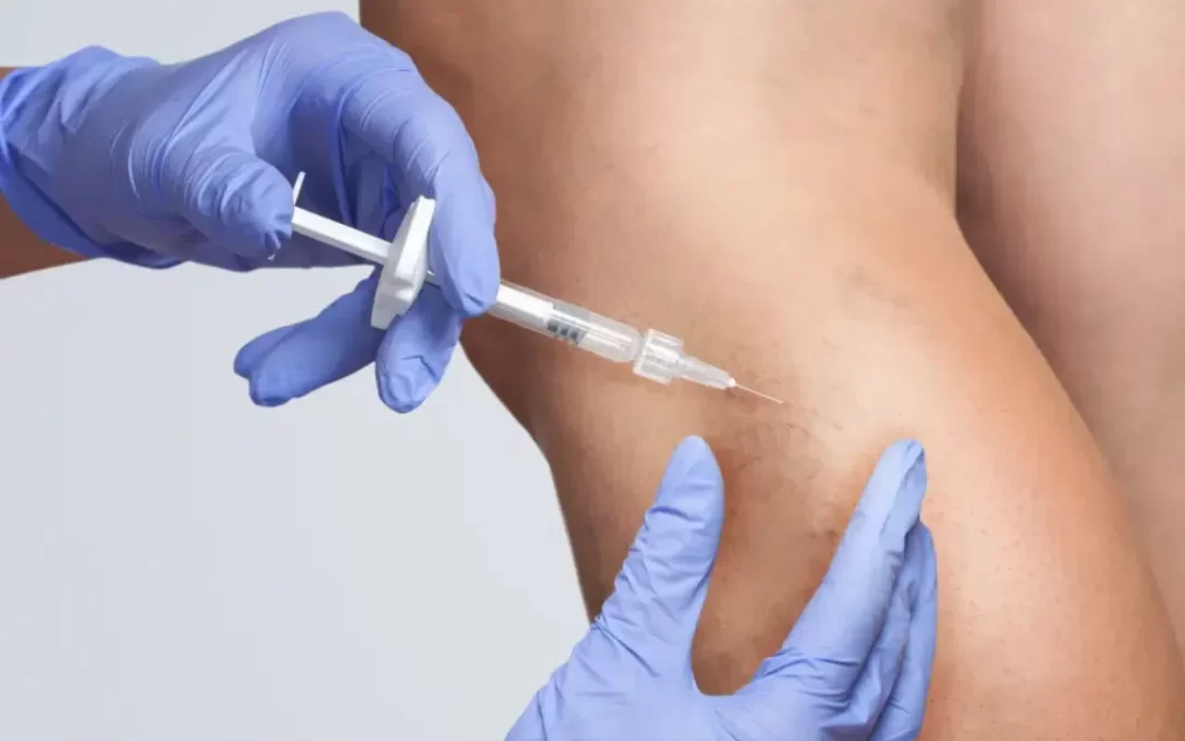 Escleroterapia com espuma para varizes e vasinhos
