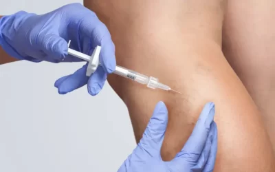 Escleroterapia com espuma para varizes e vasinhos