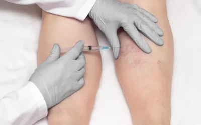 Escleroterapia com glicose: elimine vasinhos com segurança