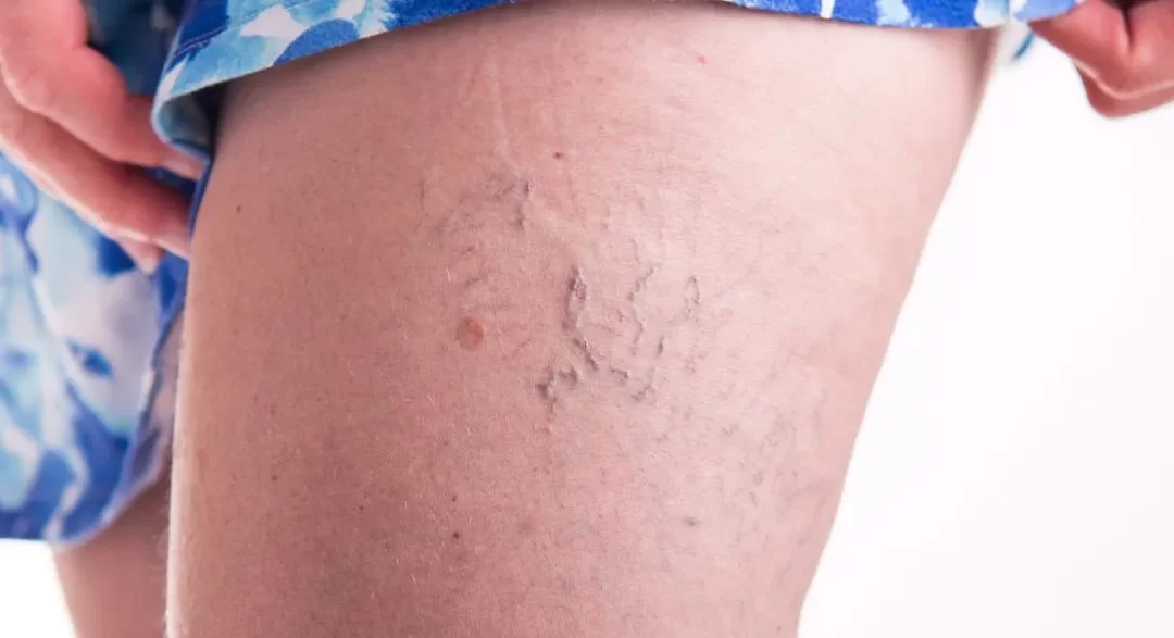 Especialista em varizes: quando procurar ajuda?