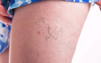 Especialista em varizes: quando procurar ajuda?