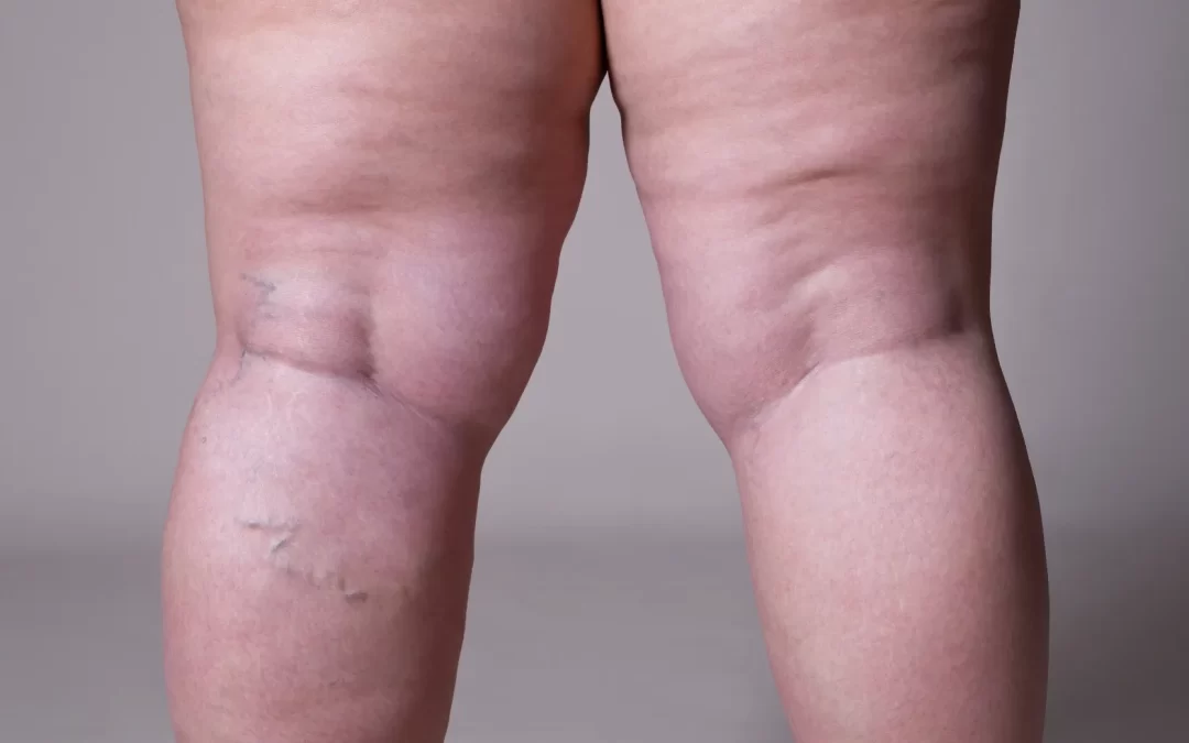 Lipedema: muito mais que gordura nas pernas