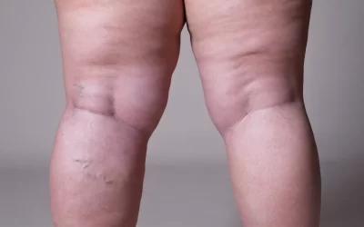 Lipedema: muito mais que gordura nas pernas