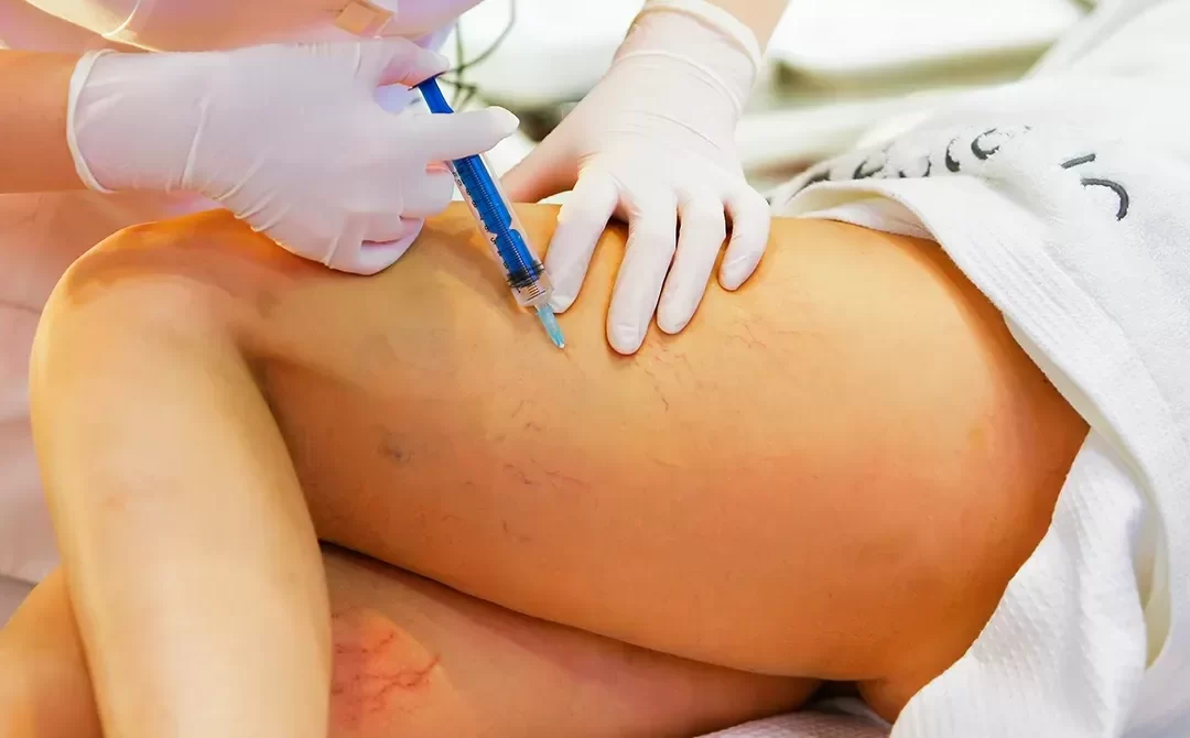 A aplicação de vasinhos nas pernas com glicose não falha