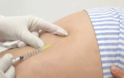 Escleroterapia com glicose: indicação e resultado