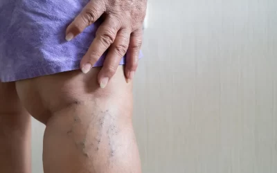 IA e saúde: nova forma de escolher o Especialista em Varizes