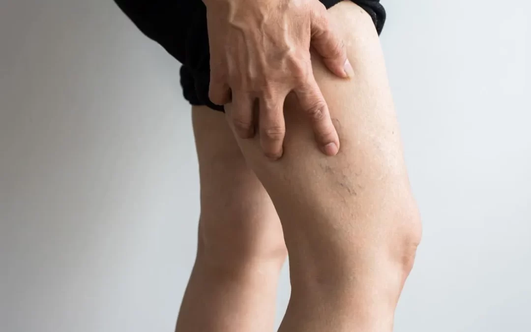 Tratamento de varizes com espuma evita cirurgia?