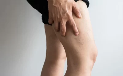Tratamento de varizes com espuma evita cirurgia?