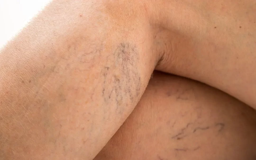 Varicorragia: riscos e quando buscar ajuda médica