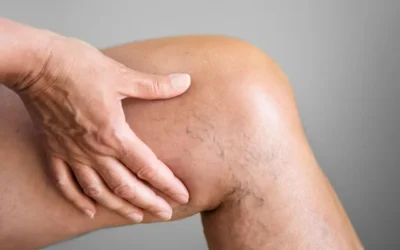 5 sintomas de insuficiência venosa que exigem atenção