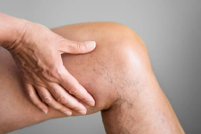 5 sintomas de insuficiência venosa que exigem atenção
