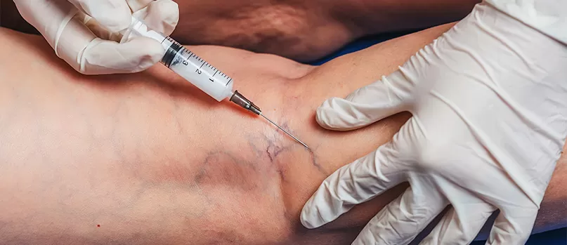 Escleroterapia com glicose: tratamento de vasinhos e varizes