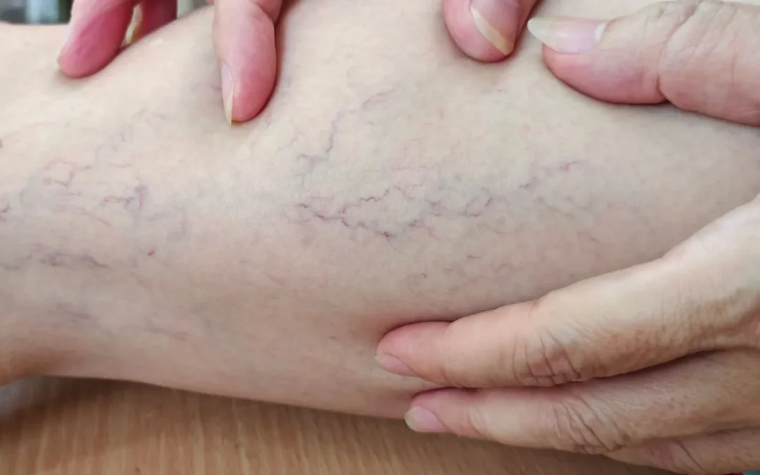 Varizes têm cura? O que a ciência diz sobre o tratamento