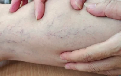 Varizes têm cura? O que a ciência diz sobre o tratamento