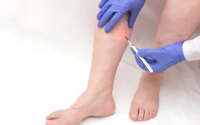 Laser para varizes: guia completo com o Dr. João Maffei