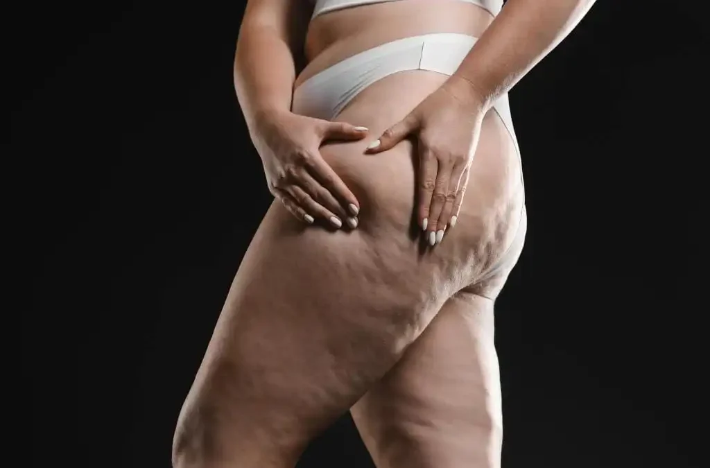 Tratamento de lipedema: diagnóstico, sintomas e cuidados