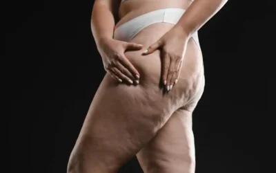 Tratamento de lipedema: diagnóstico, sintomas e cuidados